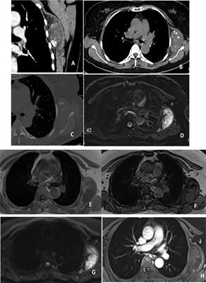 Adult hamartoma of the chest wall: A case report